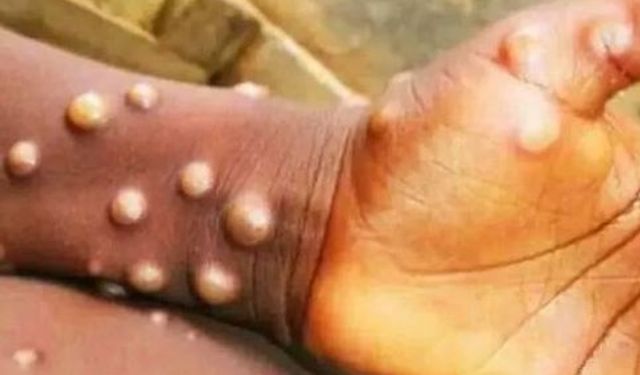 Kocaeli'de Maymun Çiçeği Vakası Yalanlandı: Sağlık Müdürlüğü'nden Açıklama